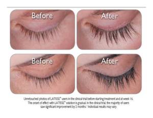 eyelashes-before-and-after-001